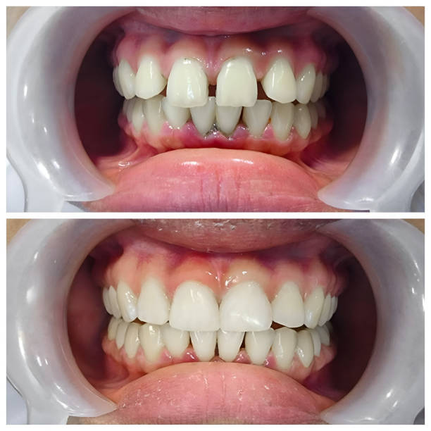 Full Mouth Reconstruction in Oakleaf Plantation, FL